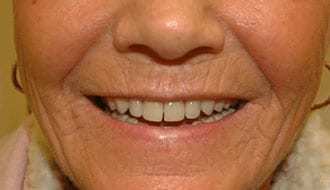 before and after images - The Denture Practice