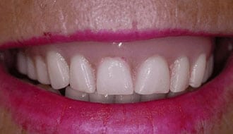 before and after images - The Denture Practice
