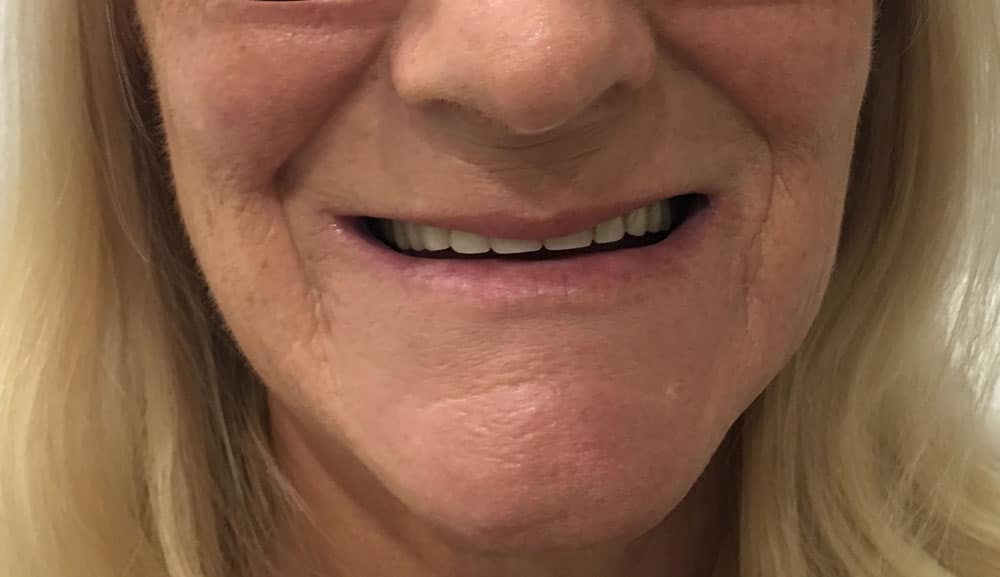 before-dentures-bad-teeth-womanbefore and after images - The Denture Practice