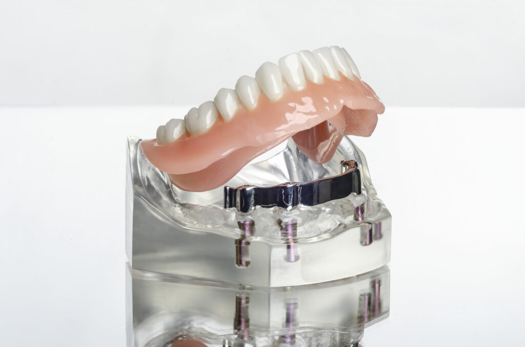 Implanr Retained Dentures from The Denture Practice